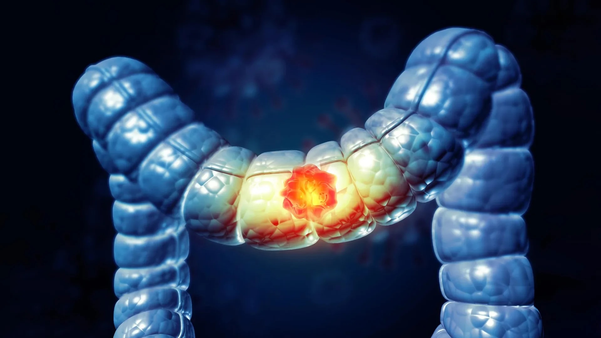 At home colon cancer screening linked to a 43% reduced risk of dying from it preview image