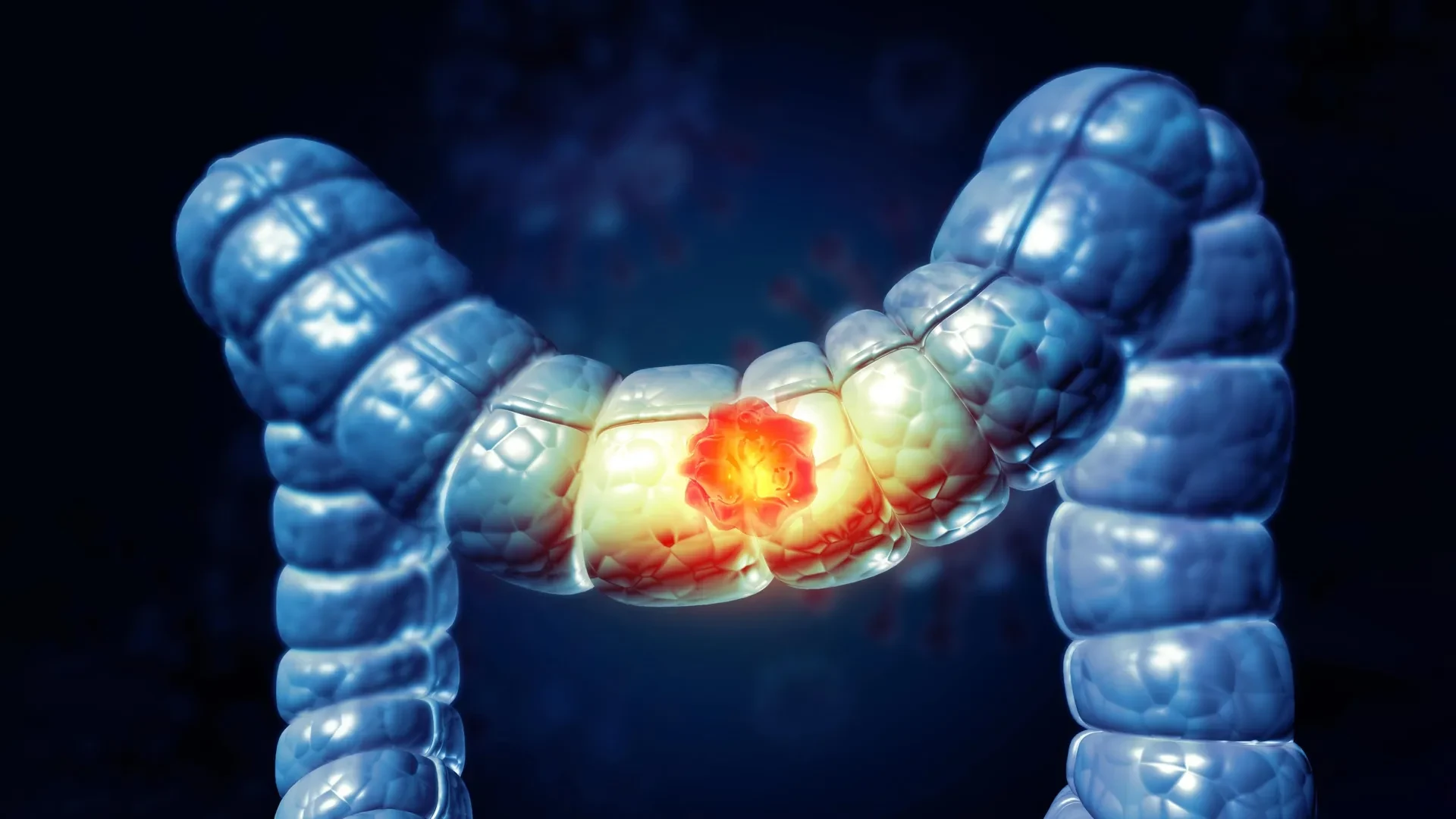 A simple at-home test could cut colorectal cancer death risk by 43% preview image