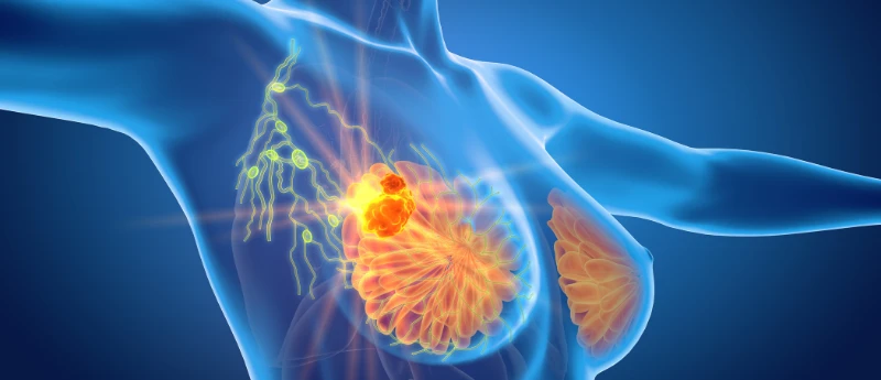 Study Finds More Breast Cancer Patients Can Skip Lymph Node Surgery preview image